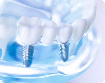 インプラントの写真